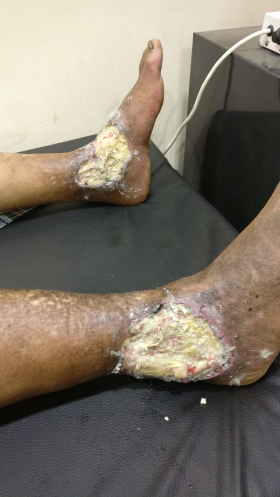 Venous Ulcer in Ankle
